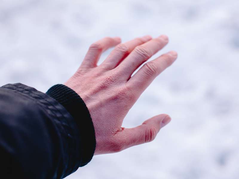 frostbite symptoms in hand